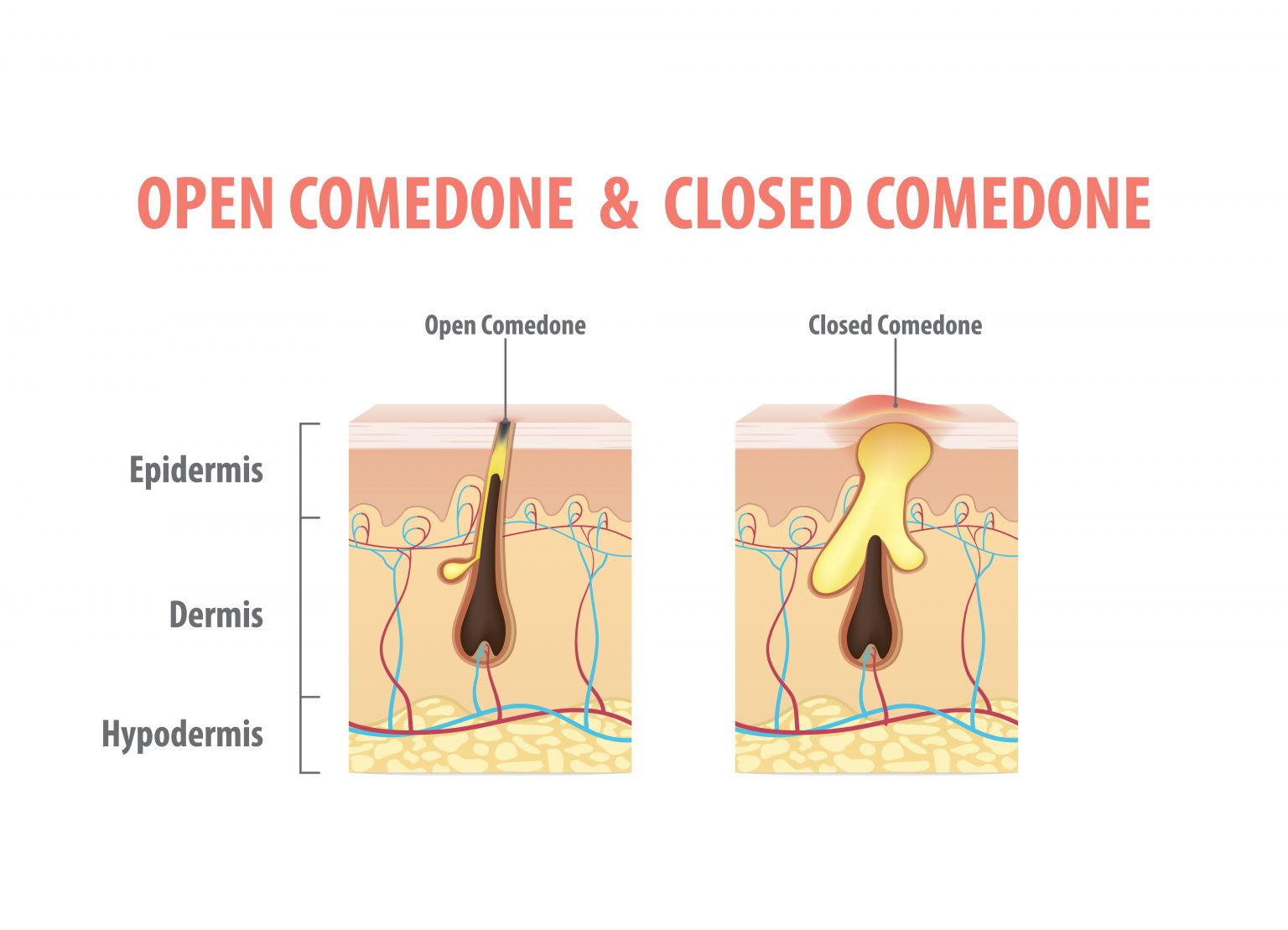 How To Treat Closed Comedones | ChatterSource
